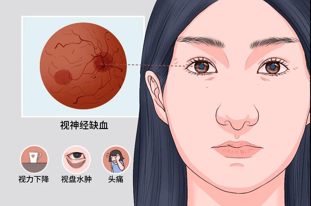 缺血性視神經(jīng)病變，該試試高壓氧了